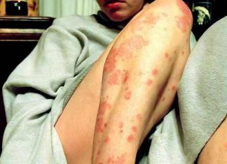 Pflegecremes für Neurodermitis und Psoriasis