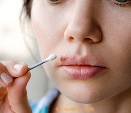 Herpes mit natürlichen Mitteln behandeln
